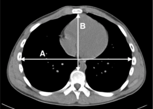 Fig. 2. Measurement of the Haller index. The Haller index is defined as maximal internal transverse diameter of the chest (A) divided by the anteroposterior diameter between the sternum and the vertebral bodies (B) on axial CT images.