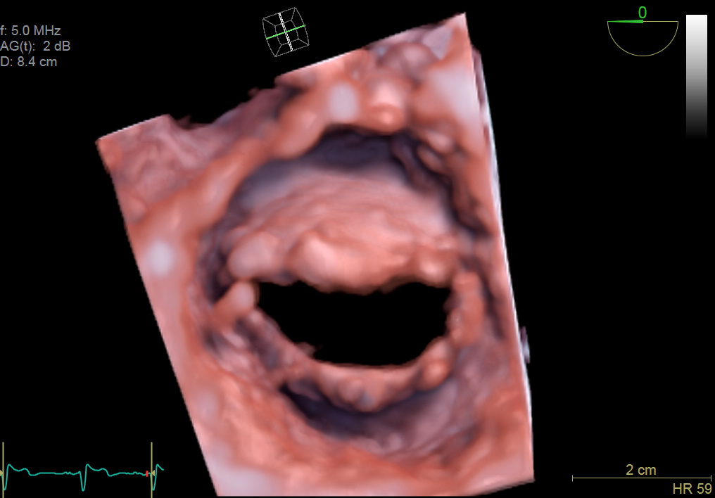 3D view of human heart mitral valve. GE Ultrasound