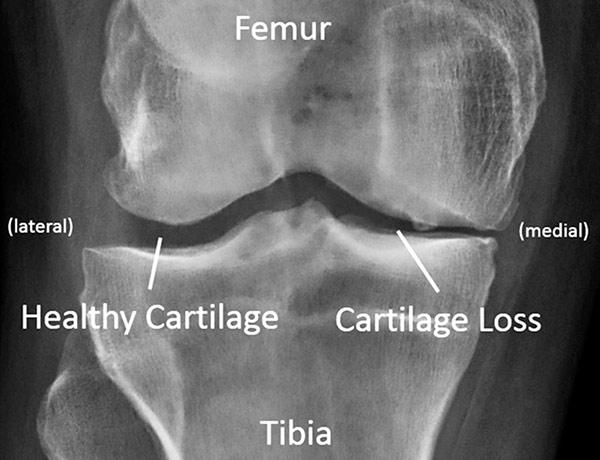 Figure 2: Standing knee x-ray for an individual with medial compartment knee osteoarthritis. The loss of articular cartilage is evident in the narrower gap in the medial compartment.
