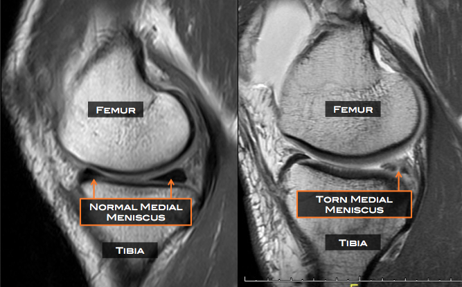 Not all meniscal pathology is relevant in patients with ...