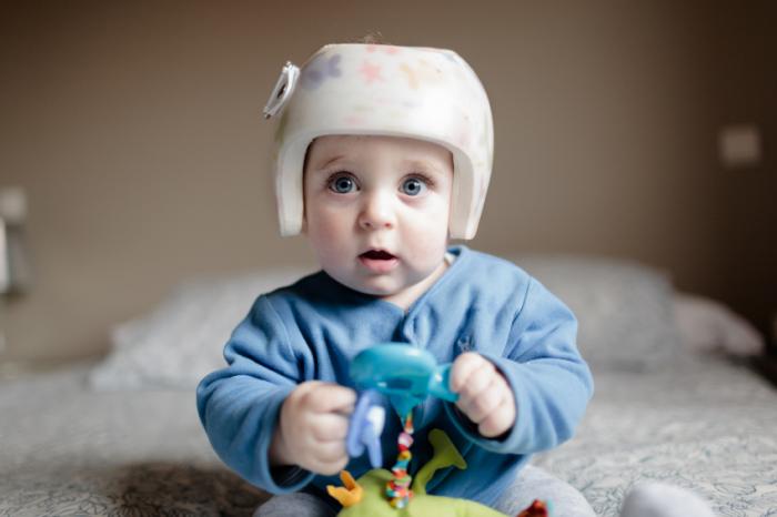 why do some babies wear plastic helmets
